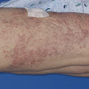 Dermatomal distribution of grouped erythematous papules 