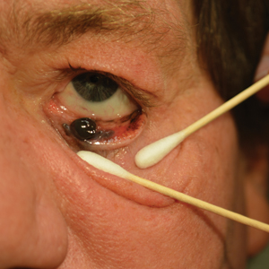 Conjunctival melanoma. A large pigmented mass on the left lower eyelid. 