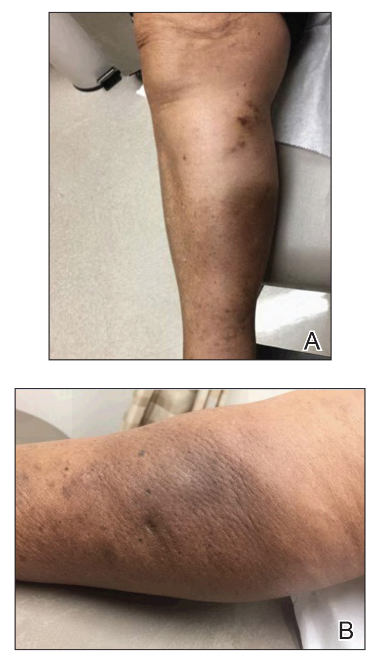 Medial and posterior view, respectively, of a hyperpigmented and indurated plaque on the posterior lower right leg