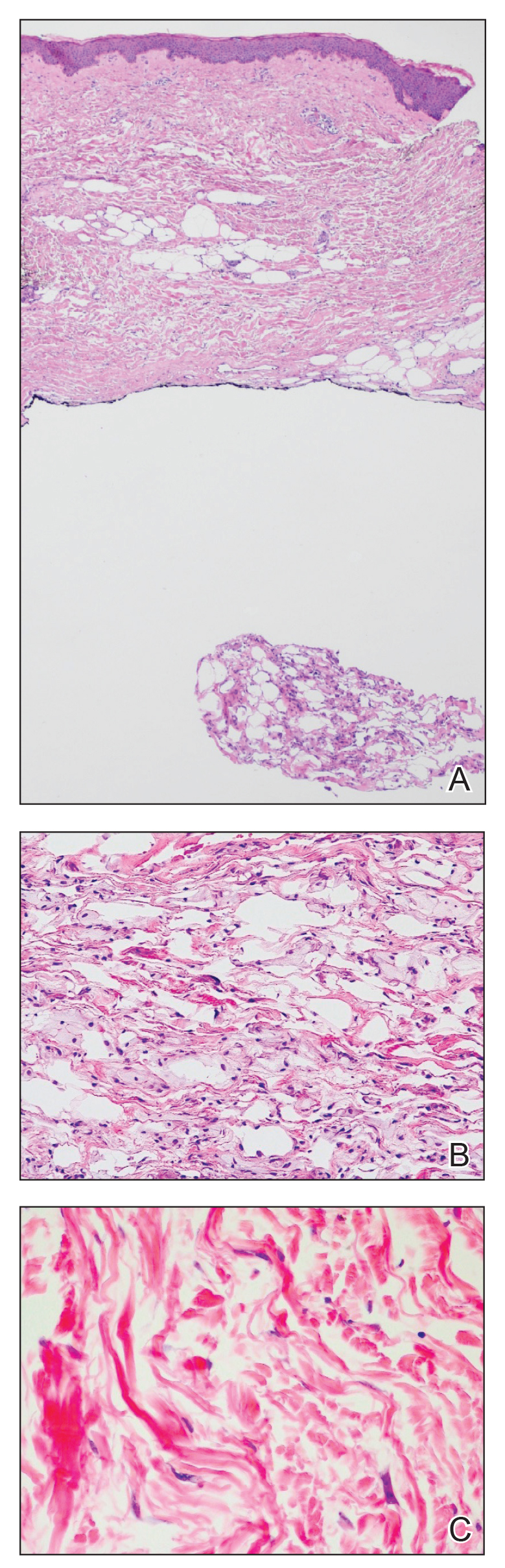 The dermis appeared mildly sclerotic with epidermal thinning, attenuated rete ridges, and mild compact hyperkeratosis