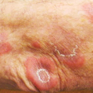 Indurated erythematous papules and plaques on the arm, some with an annular or arcuate configuration with trailing scale