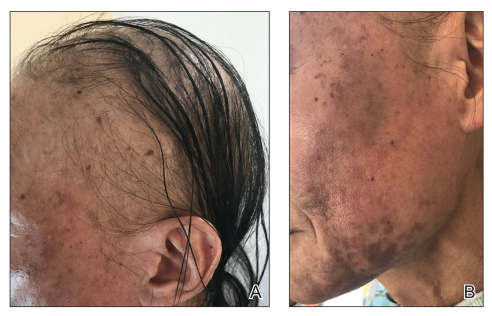 Alopecia with preferential sparing of the occipital scalp. 