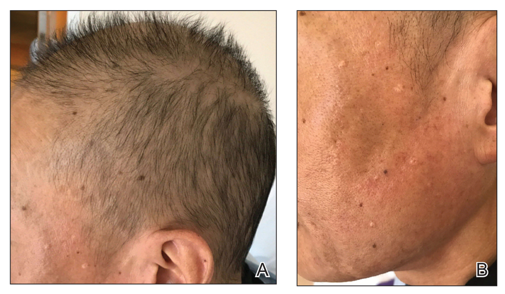 Early hair regrowth and resolution of facial patches, respectively, 2 weeks after discontinuation of albendazole.