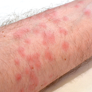 Presentation of diver’s dermatitis on the arm, with distribution limited to an area that was directly exposed to water