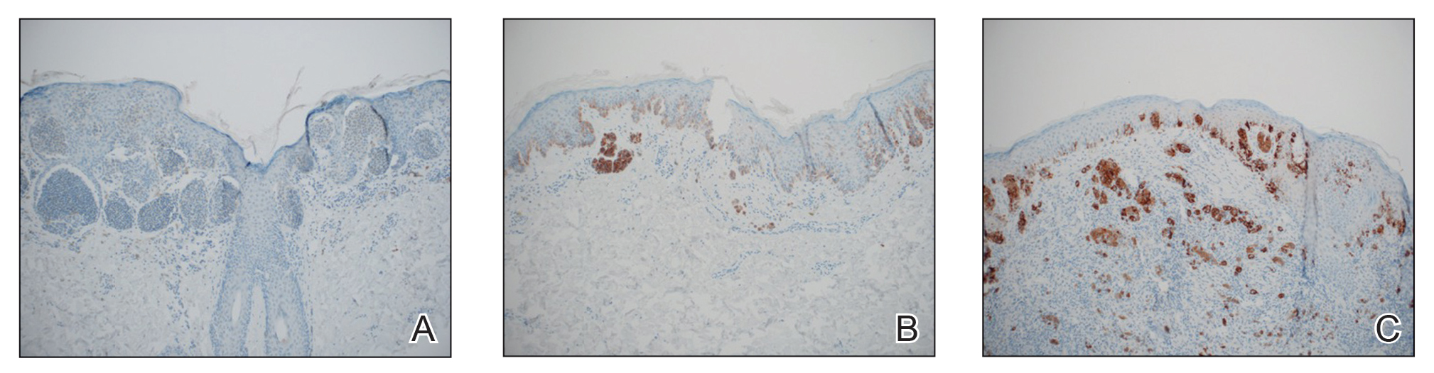 Examples of staining of melanocytes in melanomas for BRAF V600E