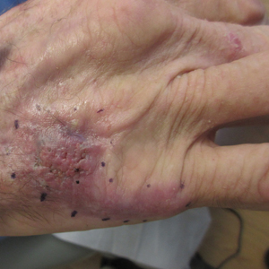 Nonhealing violaceous plaque of the hand