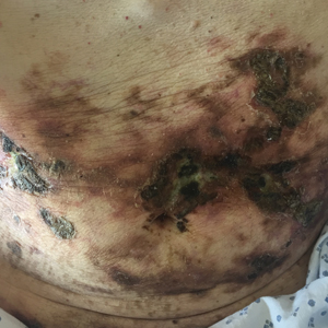 Large purpuric to brown plaques in a retiform configuration with central necrotic eschars on the abdomen