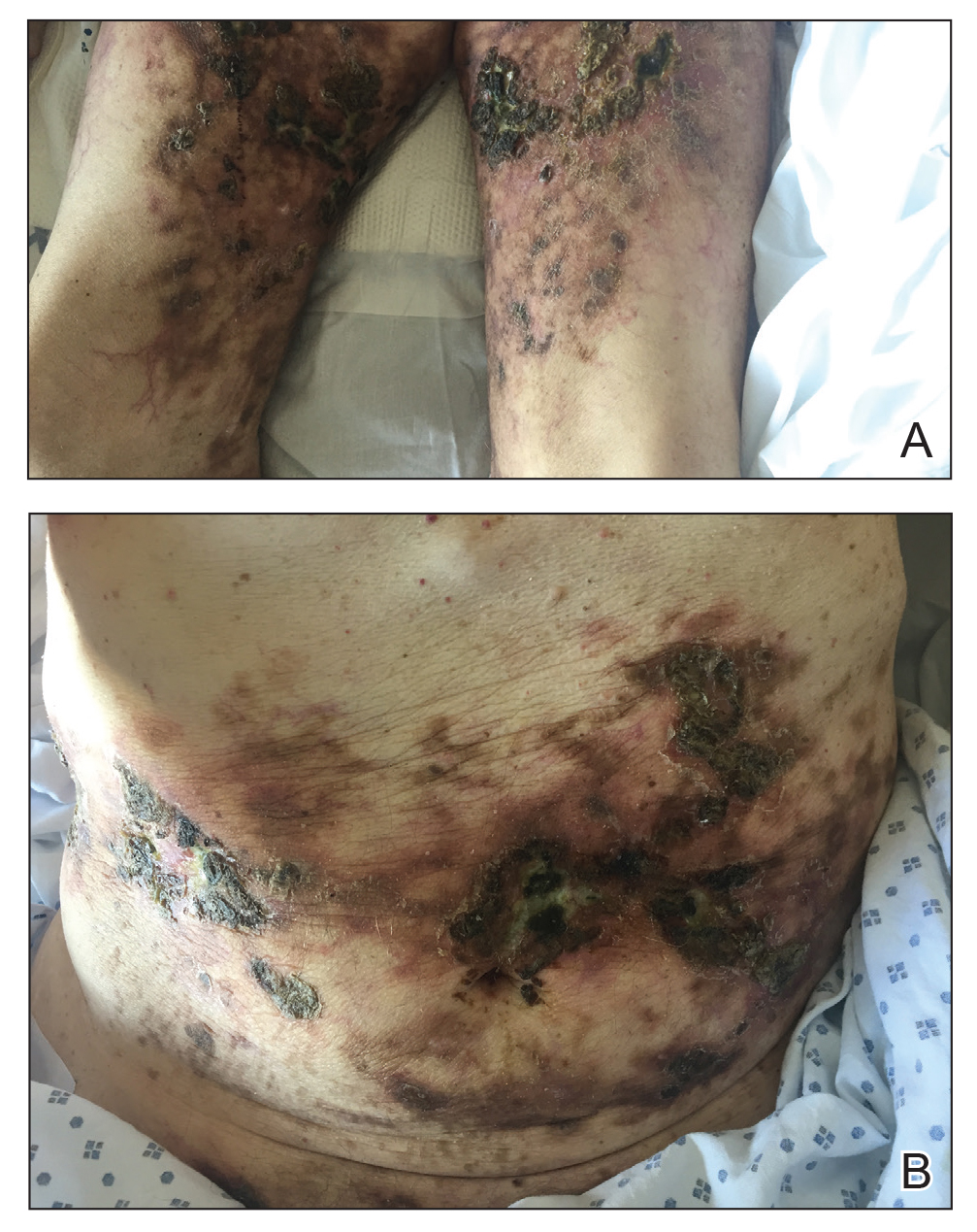 Large purpuric to brown plaques in a retiform configuration with central necrotic eschars on the thighs and abdomen