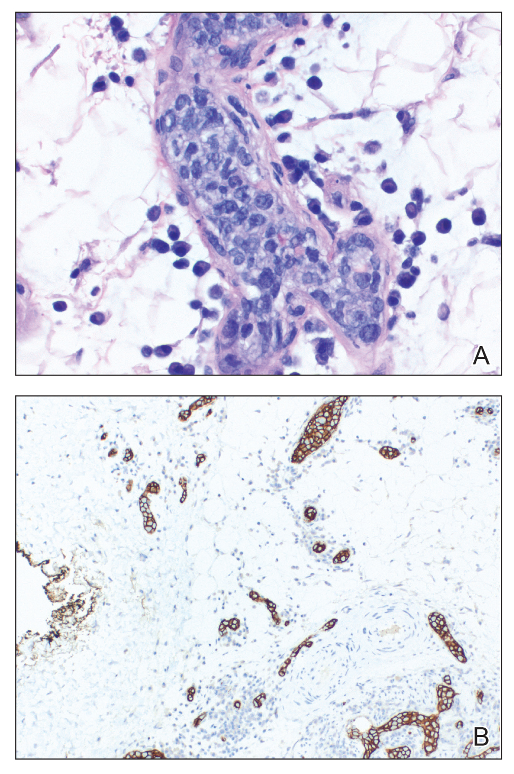 A, An incisional skin biopsy demonstrated large atypical lymphocytes within small capillaries of the deep dermis and subcutaneous fat (H&E, original magnification ×40). B, CD20 immunohistochemical staining highlighted atypical B cells