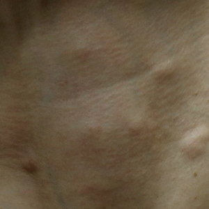 Multiple subcutaneous nodules developed on the neck 3 weeks after poly-L-lactic acid injection.