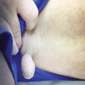 Nevus lipomatosis on the left medial thigh