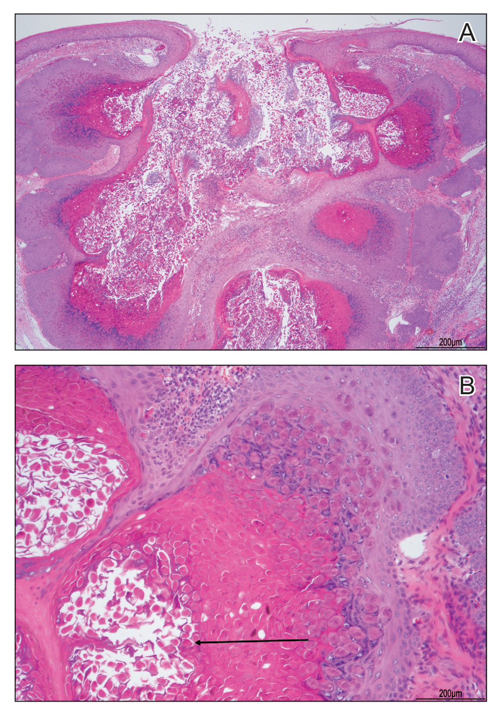 Histopathologic examination of the molluscum contagiosum plaque after shave removal demonstrated pathognomonic intracytoplasmic inclusion bodies (black arrow)(H&E, original magnifications ×4 and ×20). Reference bars indicate 200 µm.