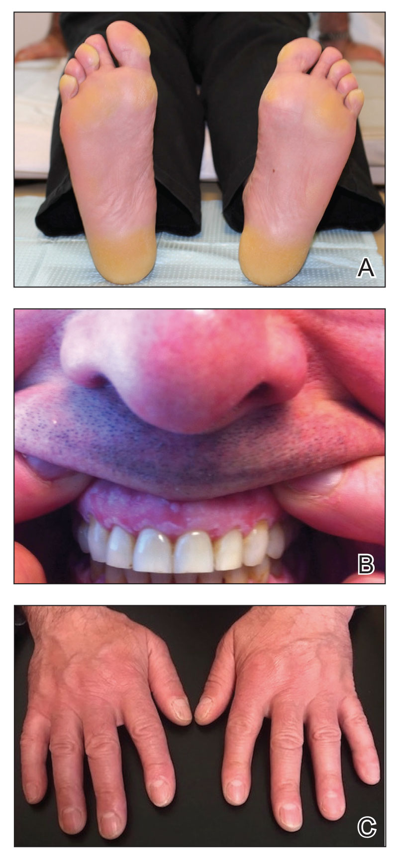 A, Painful focal keratoderma most prominent at pressure points on the soles and toes. B, Gingival hyperkeratosis and oral leukokeratosis. C, Nails without thickening of plates or discoloration.