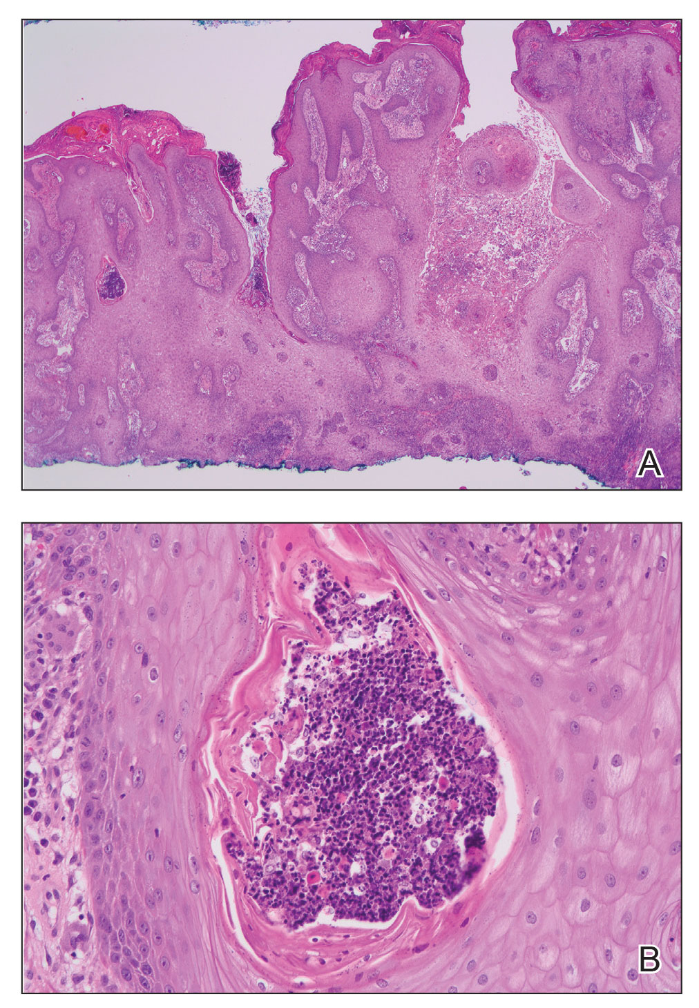 Marked pseudoepitheliomatous hyperplasia with neutrophilic microabscesses