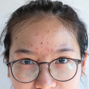 Acne on forehead