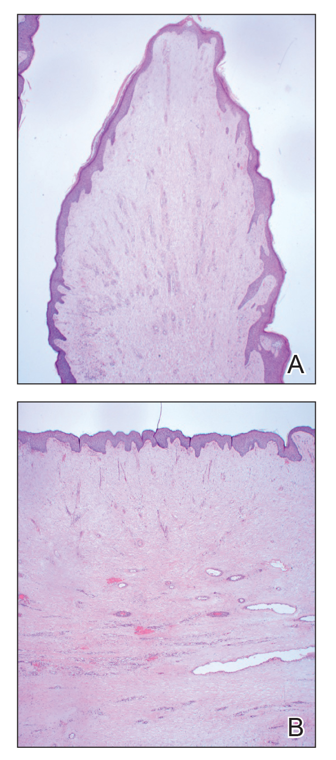 A, Benign fibroepithelial polyp with areas of hyperkeratosis, acanthosis, and focal papillomatosis (H&E, original magnification ×4). B, Dilated lymphatics, stellate fibroblasts, edematous stroma, and superficial plasmolymphocytosis