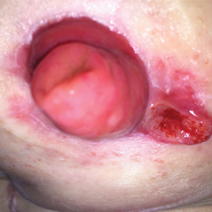 Peristomal pyoderma gangrenosum immediately adjacent to an ileostomy site