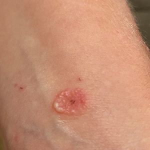 Itchy vesicular rash