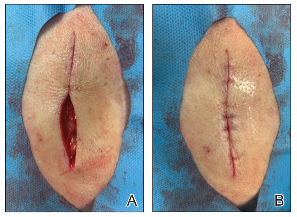  A, Defect after initial dermal suture placement. B, Defect after opposing dermal suture placement.