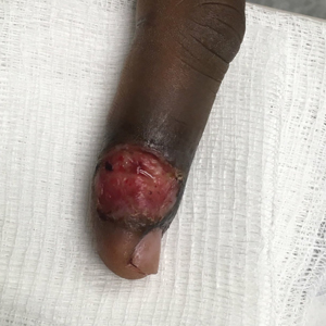 A 2-cm, well-defined, erythematous plaque with overlying erosion, serosanguineous drainage, and peripheral hyperpigmentation on the distal third finger.