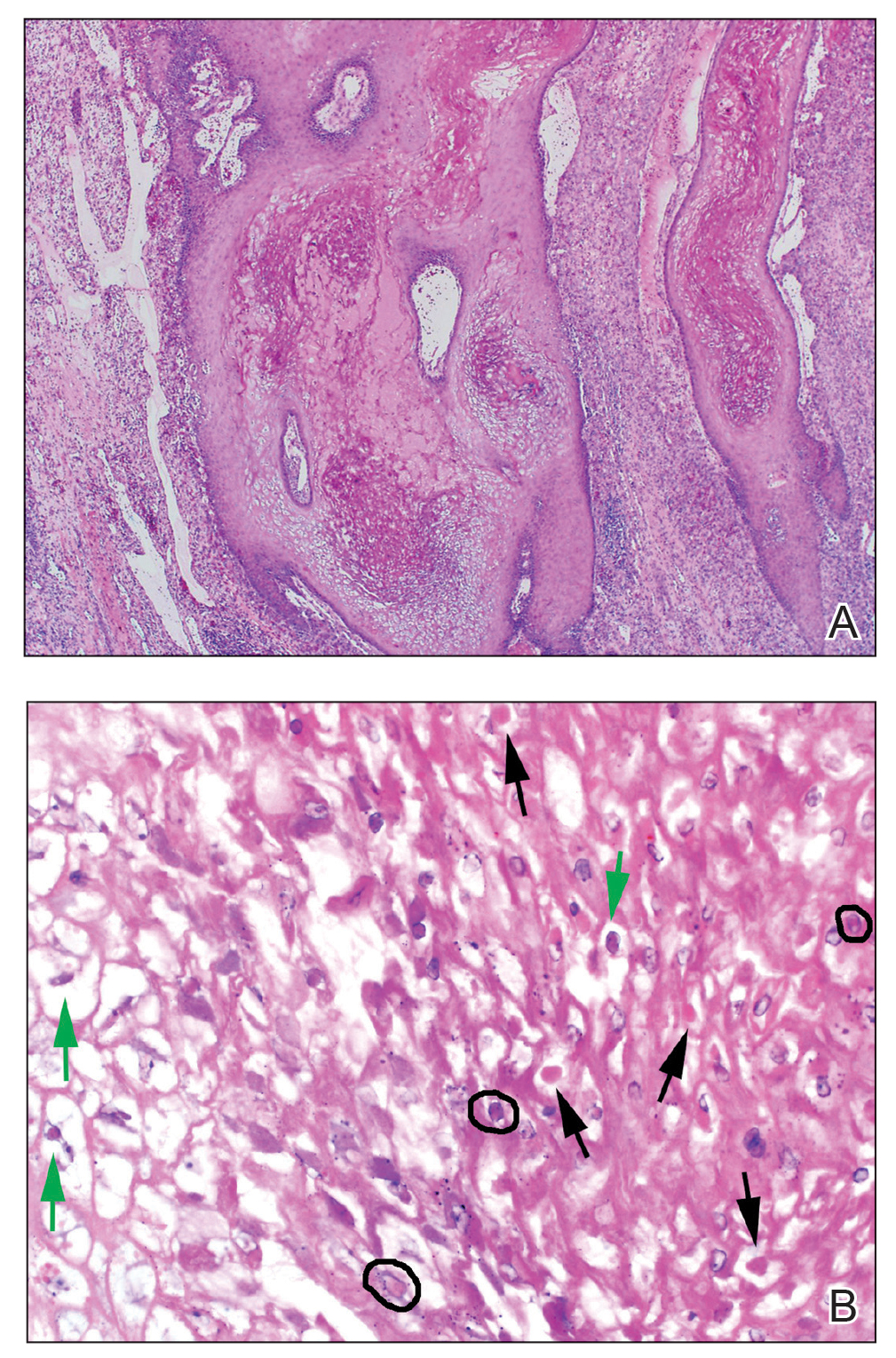 Hyperplastic follicles with balloon cell change, perinuclear vacuolization, and surrounding acute and chronic dermatitis