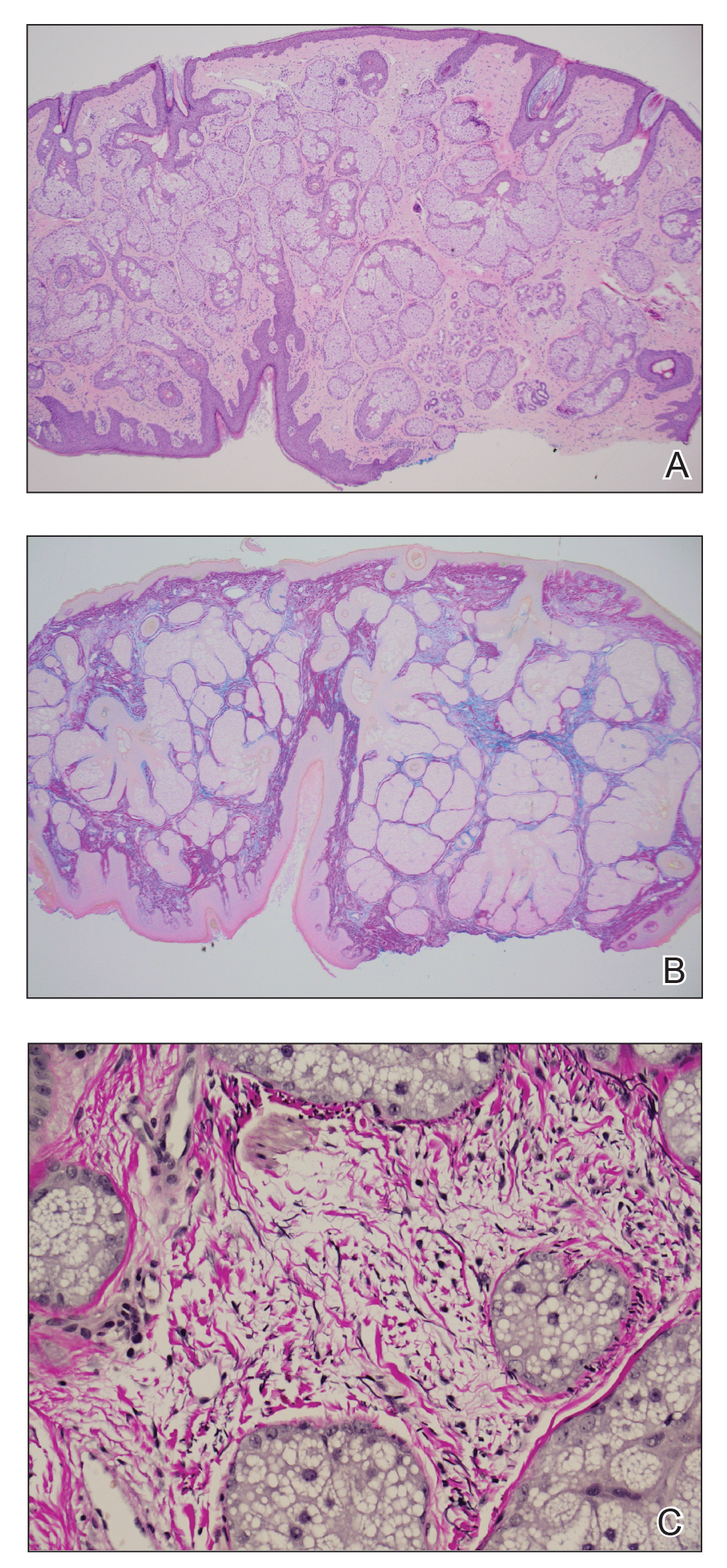 A, Histopathology of a forehead biopsy showed increased sebaceous gland occupation (H&E, original magnification ×4). B, Colloidal iron stain demonstrated increased mucin (original magnification ×4). C, Verhoeff-van Gieson stain showed elastic fiber