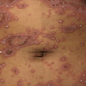 Generalized pustular psoriasis