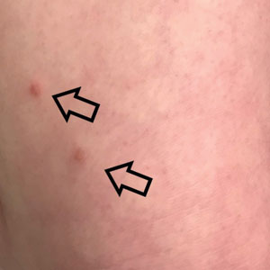 Numerous sclerotic papules (arrows) consistent with dermatofibromas