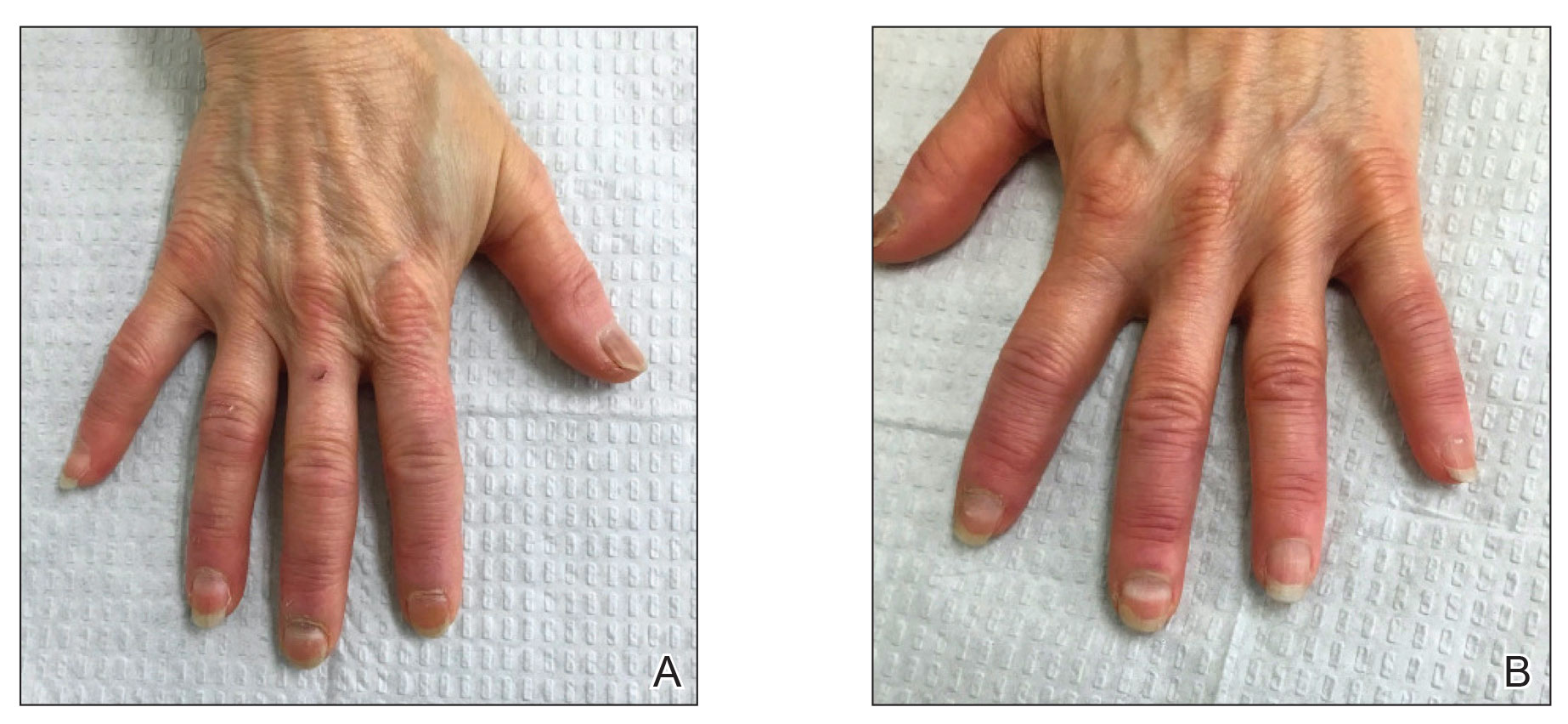 Transverse leukonychia (Mees’ lines) 5 days after the second dose of the Pfizer-BioNTech COVID-19 messenger RNA vaccine (right hand and left hand, respectively).