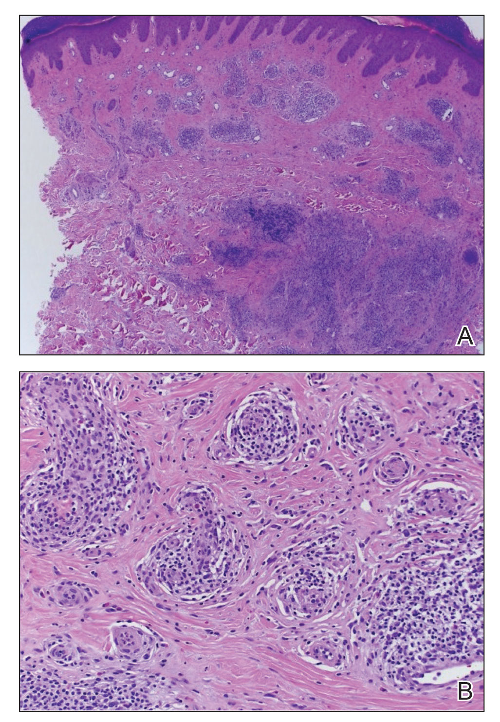 Histologic image of the right proximal pretibial lesion demonstrated a superficial and deep perivascular and interstitial infiltrate with nodular vascularity at low- and high-power views (H&E, original magnifications ×40 and ×100).