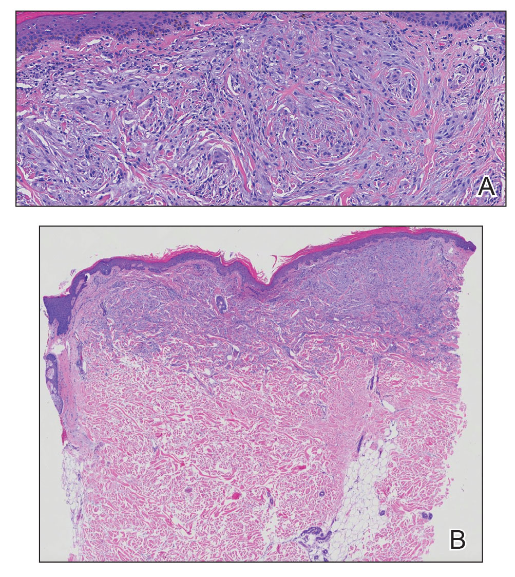 Histopathology showed increased histiocytes and abundant interstitial mucin confined to the papillary dermis (H&E, original magnifications ×100 and ×10).