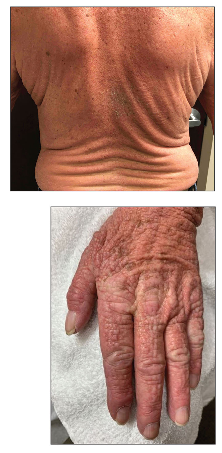 Scattered flesh-colored papules in a linear array in the setting of diffuse skin thickening