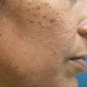 Pigmented papules on the face