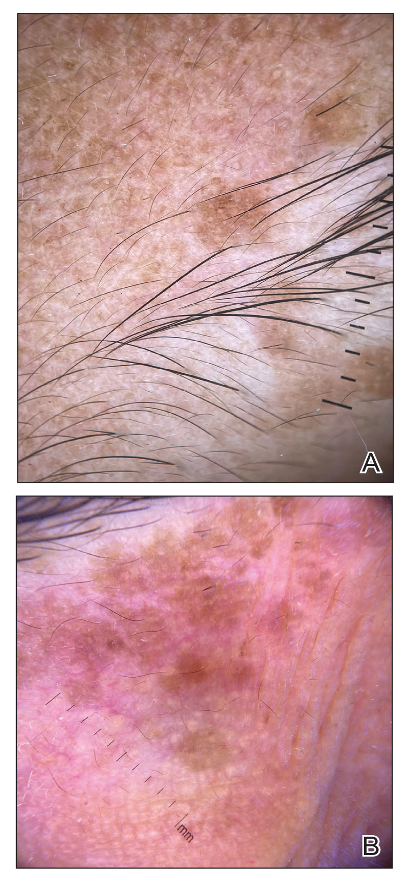 A, Dermoscopic evaluation revealed reticular light brown lines, structureless light brown areas, and reticular vessels on a faint background (original magnification ×10). B, Glittering yellow-whitish round structures over a fading pink-brown background