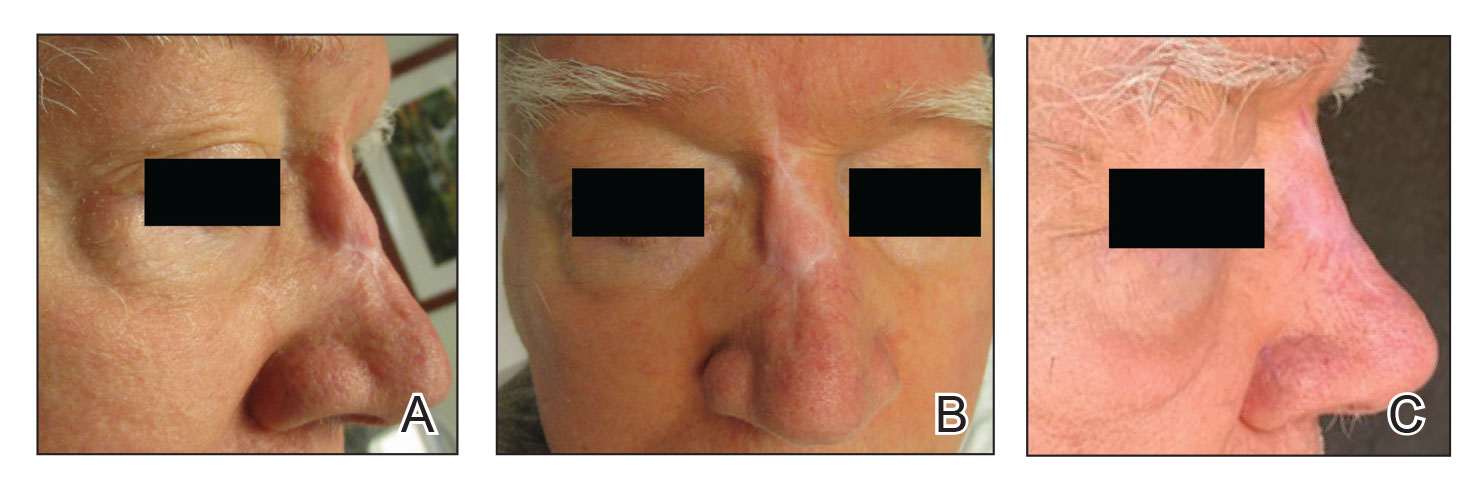 A and B, Primary scar following bilateral V-Y advancement showing pincushioning, atrophic scarring, and webbing. C, Scar 4 months after surgical defatting and Z-plasty.