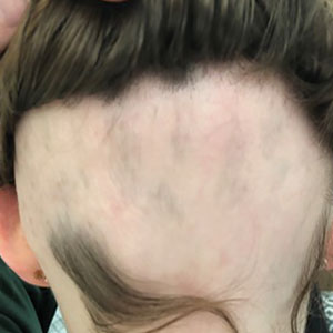 An 11-year-old girl with alopecia areata of the occipital scalp before treatment