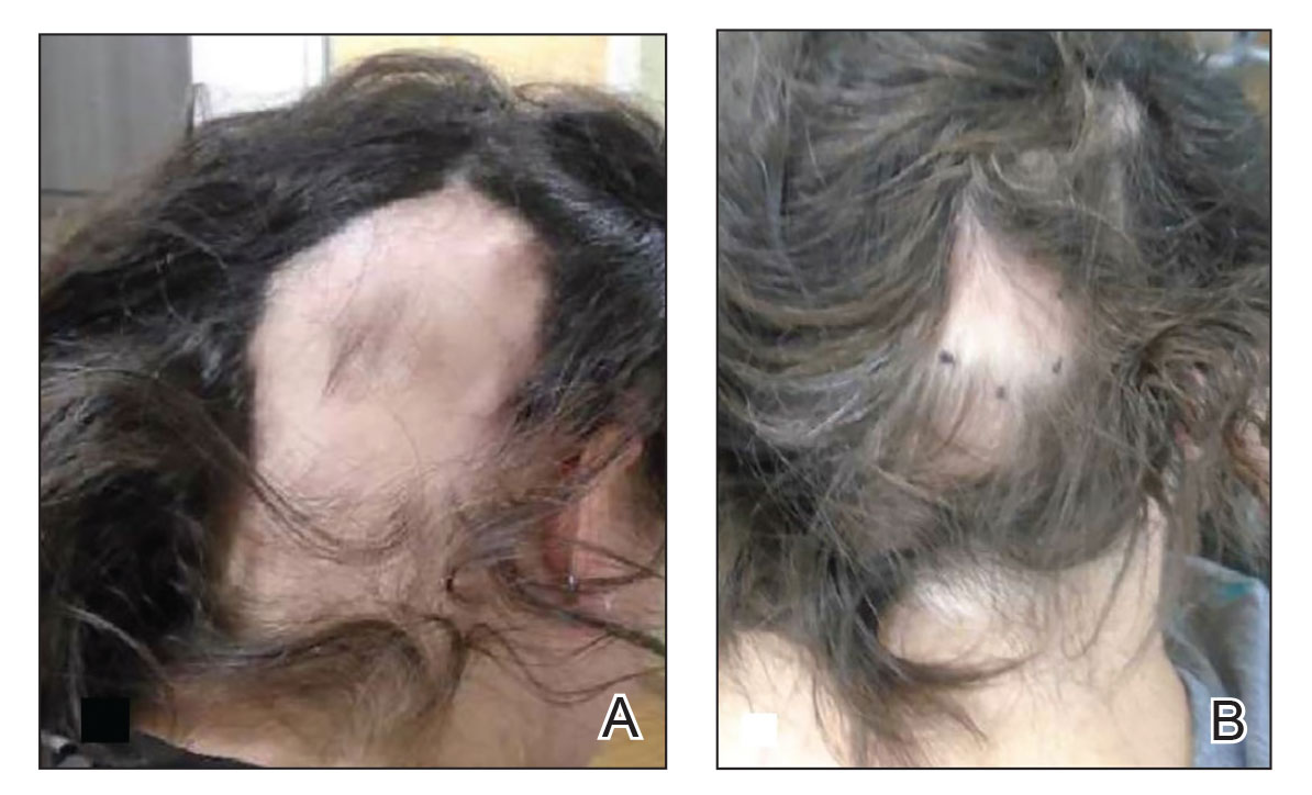 A Permanent Hair Loss in a Patient with Hypersensitivity to Intralesional  Triamcinolone Injection