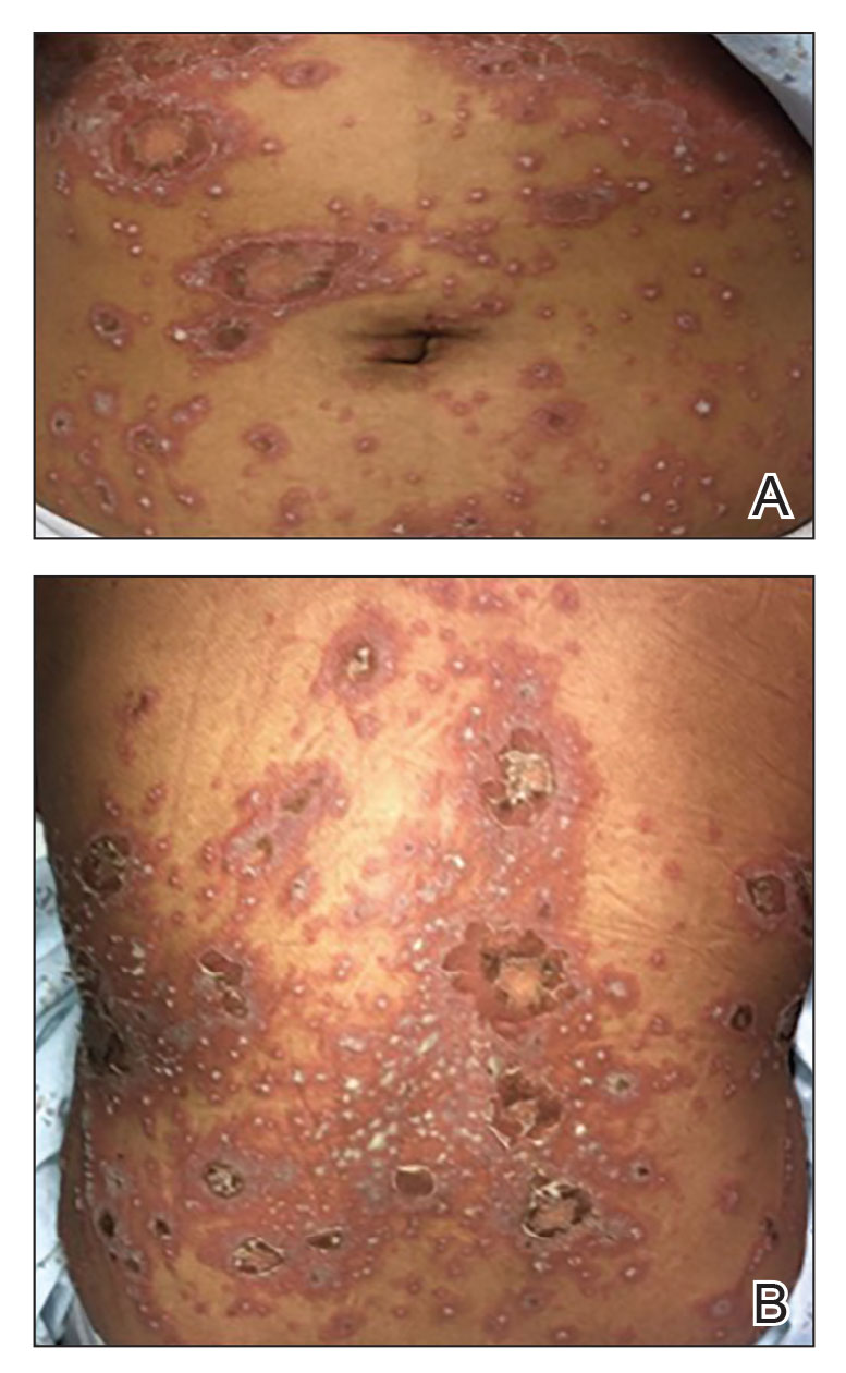 Generalized pustular psoriasis with widespread 2- to 3-mm pustules on erythematous skin or within psoriasiform plaques, respectively