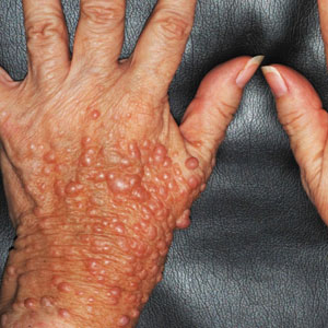 A 20-mm café-au-lait macule on the right dorsal hand had been present since birth.