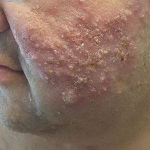 Pink, erythematous, indurated plaques heavily studded with papules, pustules, and nodules on the cheek