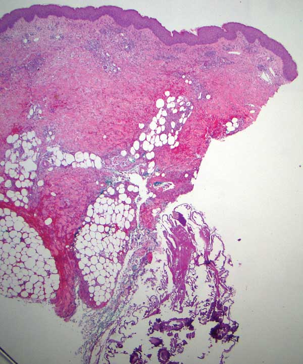 Histopathology revealed superficial and deep eosinophilrich inflammation, fibrosis, and hemorrhage. 