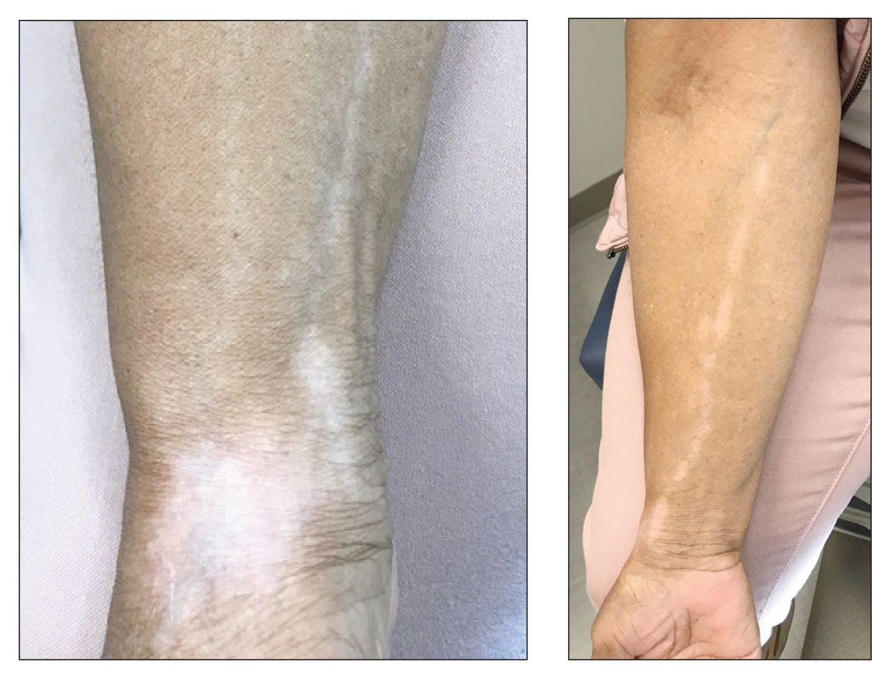 Linear hypopigmentation on the right arm