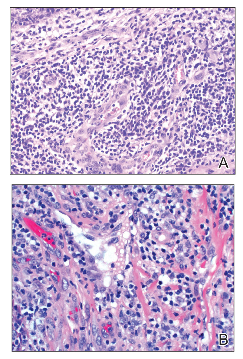 Angiolymphoid hyperplasia