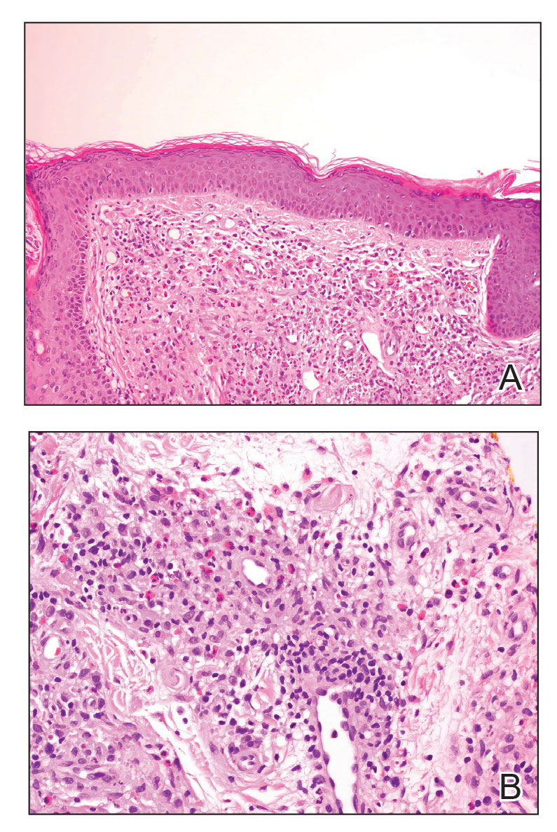 Erythematous Papule on the Nasal Ala | MDedge