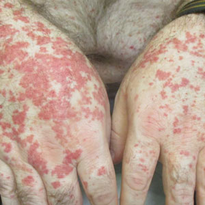 Numerous purpuric thin papules coalescing in plaques on the dorsal hands