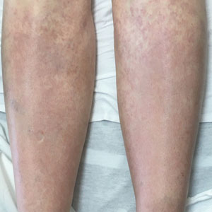 Nonblanching rash on the legs