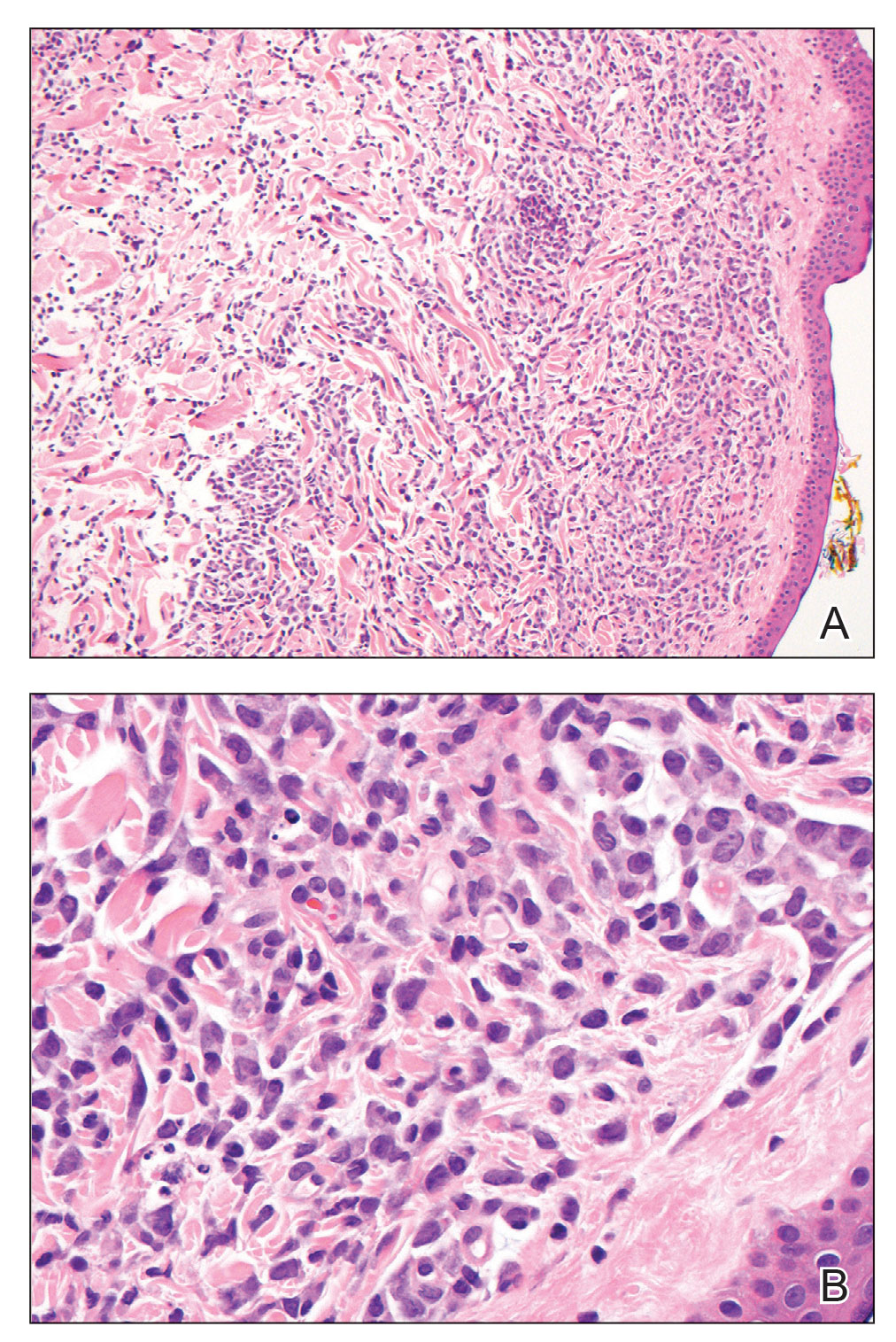 A and B, Histopathology demonstrated an infiltration of immature myeloid blasts in the dermis (H&E, original magnifications ×10 and ×400).