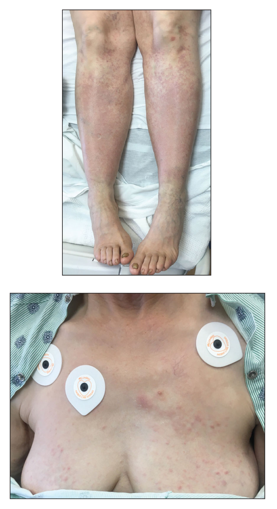 Nonblanching rash on the legs and chest