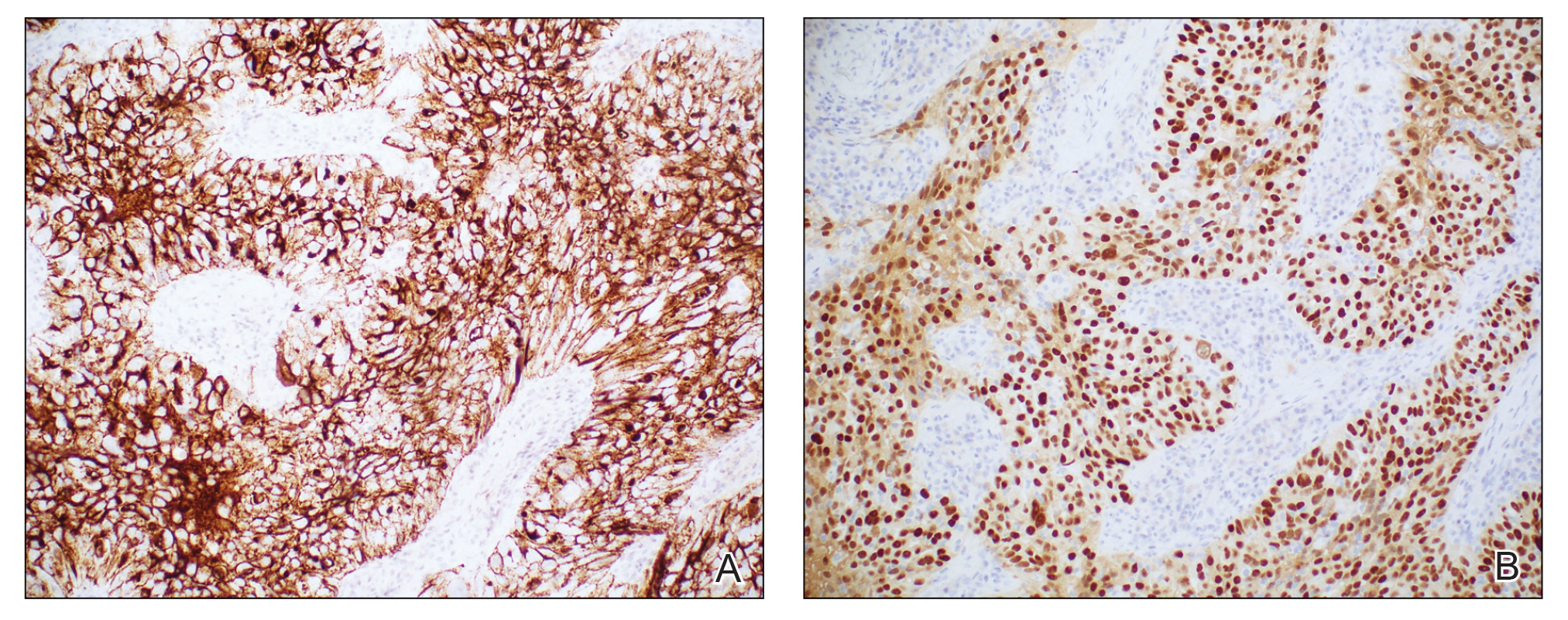 A, Densely positive cancer antigen 125 immunohistochemical staining rendered the diagnosis of primary ovarian carcinoma (original magnification ×20). B, Paired homeobox gene 8 (PAX-8) immunohistochemical staining displayed the uptake in the tumor cells