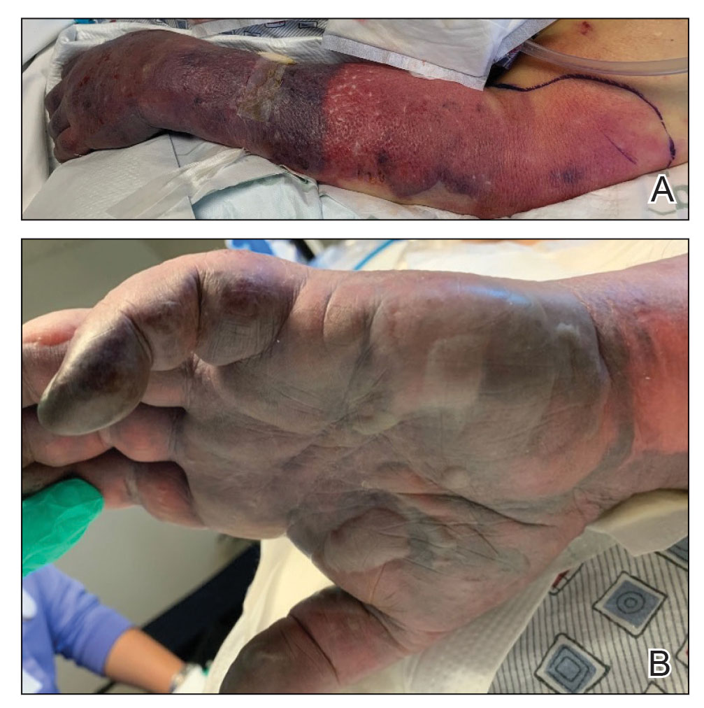 A, Erythema on the dorsal aspect of the left hand and forearm with a well-demarcated, dusky blue hue, surrounded by an erythematous border on the proximal forearm and upper arm. B, Bullae overlying darkened skin were present on the left palm.